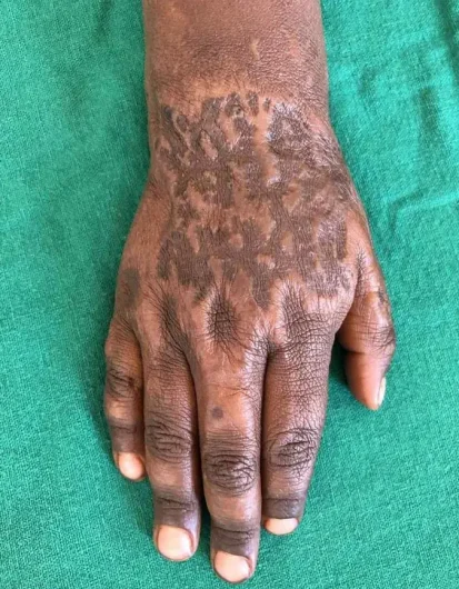 burn-marks